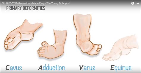 scratch test ctev|Congenital Talipes Equinovarus (CTEV).